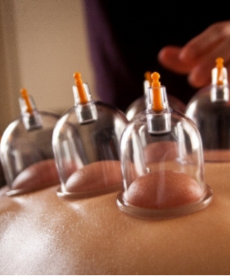 lady receiving cupping therapy